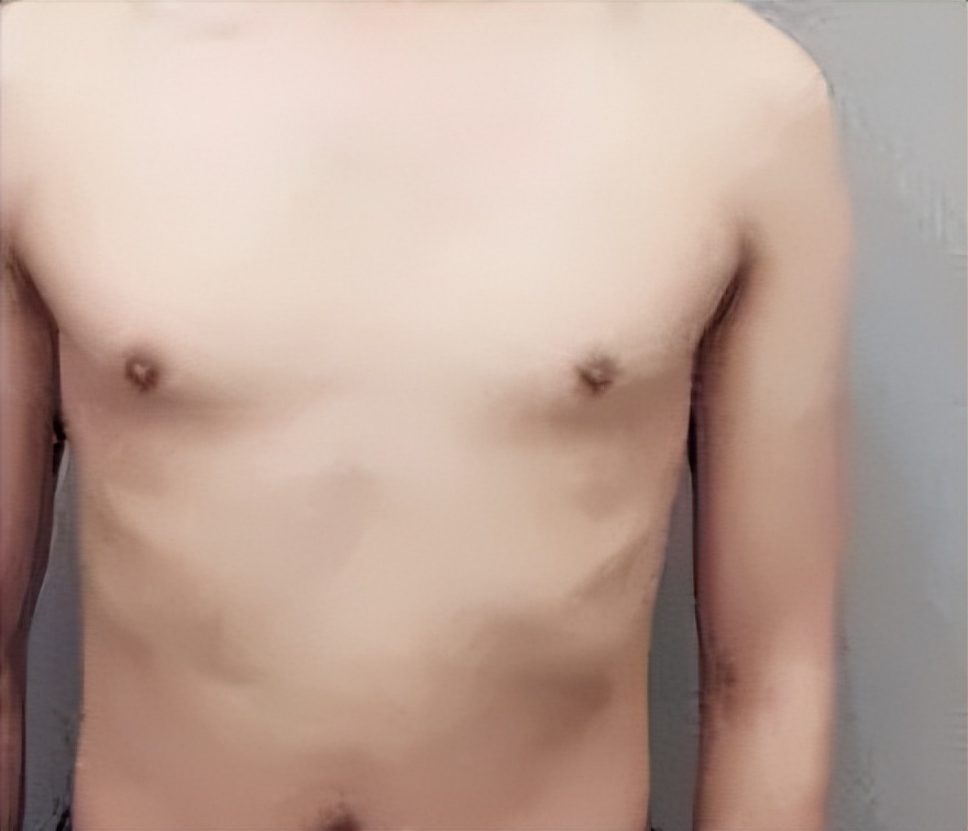 男生胸部太大的原因,男生的胸部大的原因