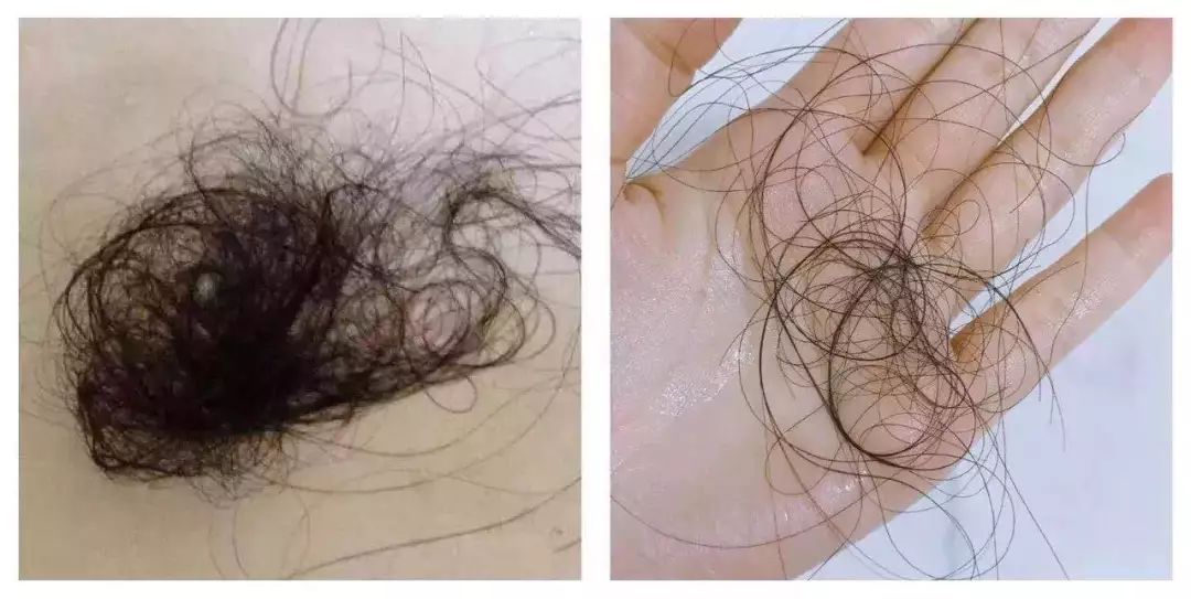 头发稀疏细软喝什么中药改善,头发稀疏细软掉发严重怎么改善