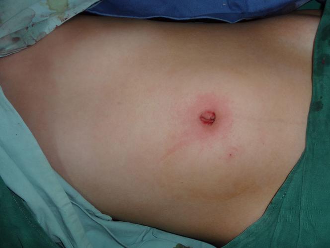 腹腔镜肾切除示意图,腹腔镜肾脏部分切除术