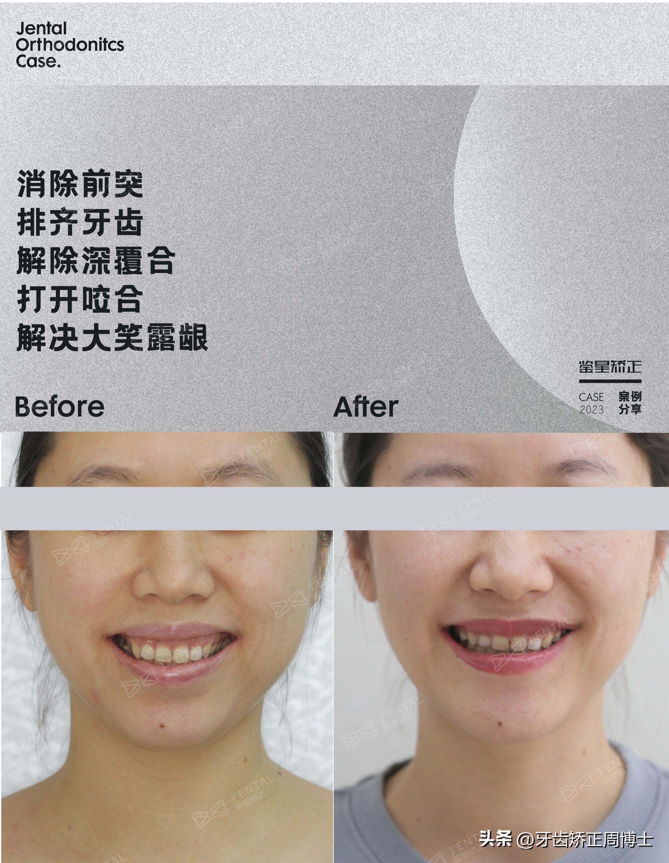 骨性龅牙怎么通过普通的矫正改善,骨钉如何解决骨性龅牙