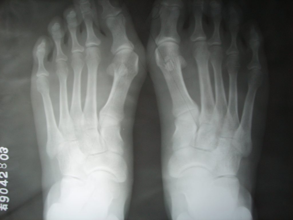 轻度的拇外翻医院有治疗的方法吗,轻度拇外翻需要治疗吗