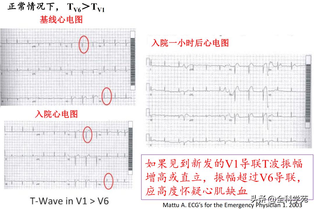 t波高尖心电图判断标准,t波高尖判断标准