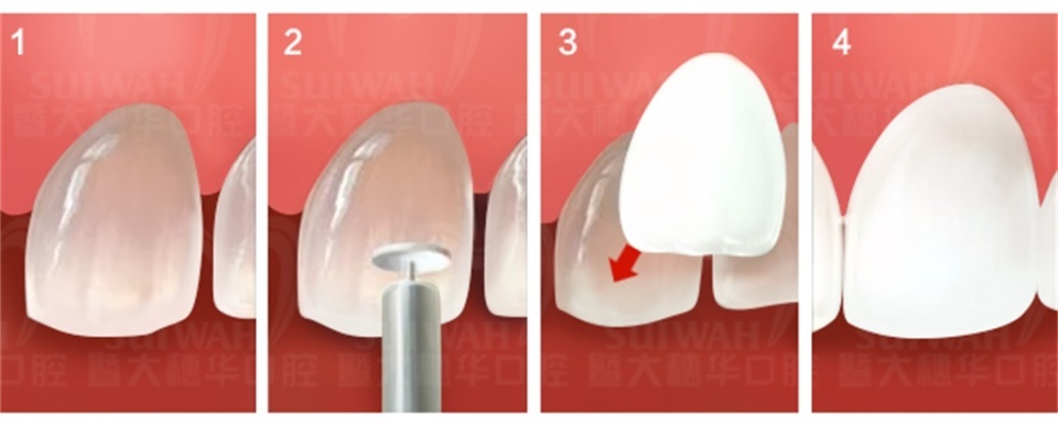 牙齿缝隙越来越大是怎么回事,45岁牙齿缝隙越来越大能矫正吗