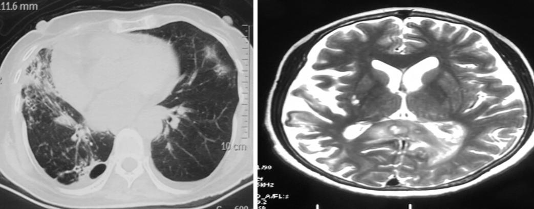 免疫缺陷病会并发什么病,什么是免疫缺陷肺部感染