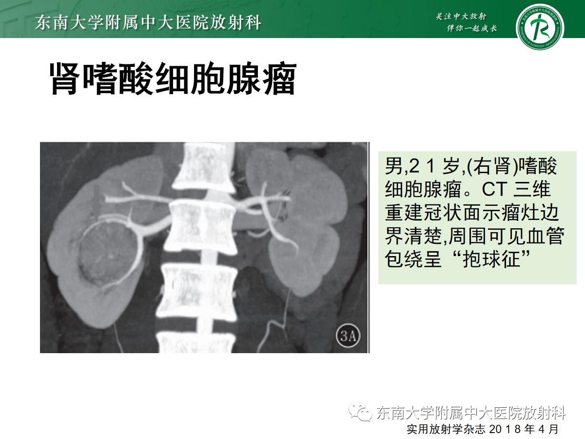 周利群谈肾嫌色细胞癌ct特点,好文分享值得深思