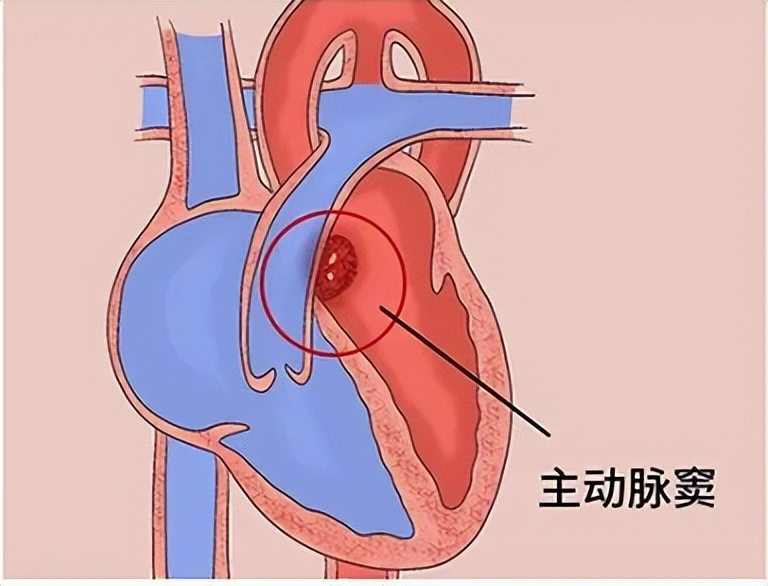左向右分流先心病,左向右分流型先心病图解