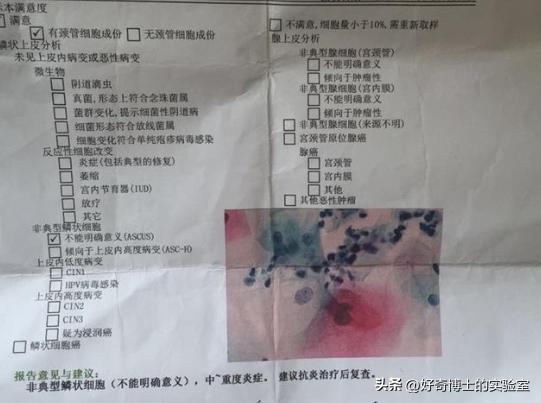 做妇科的活检是什么,妇科做活检是什么