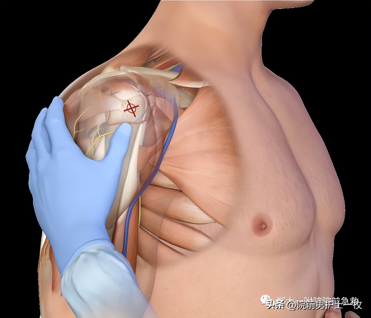 骨髓腔穿刺急救,骨髓腔穿刺适应症和禁忌症