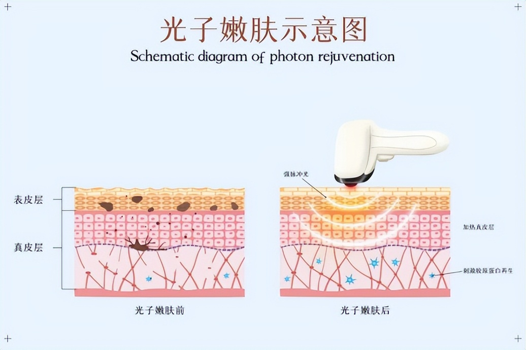 光子嫩肤祛斑术,mtt光子嫩肤