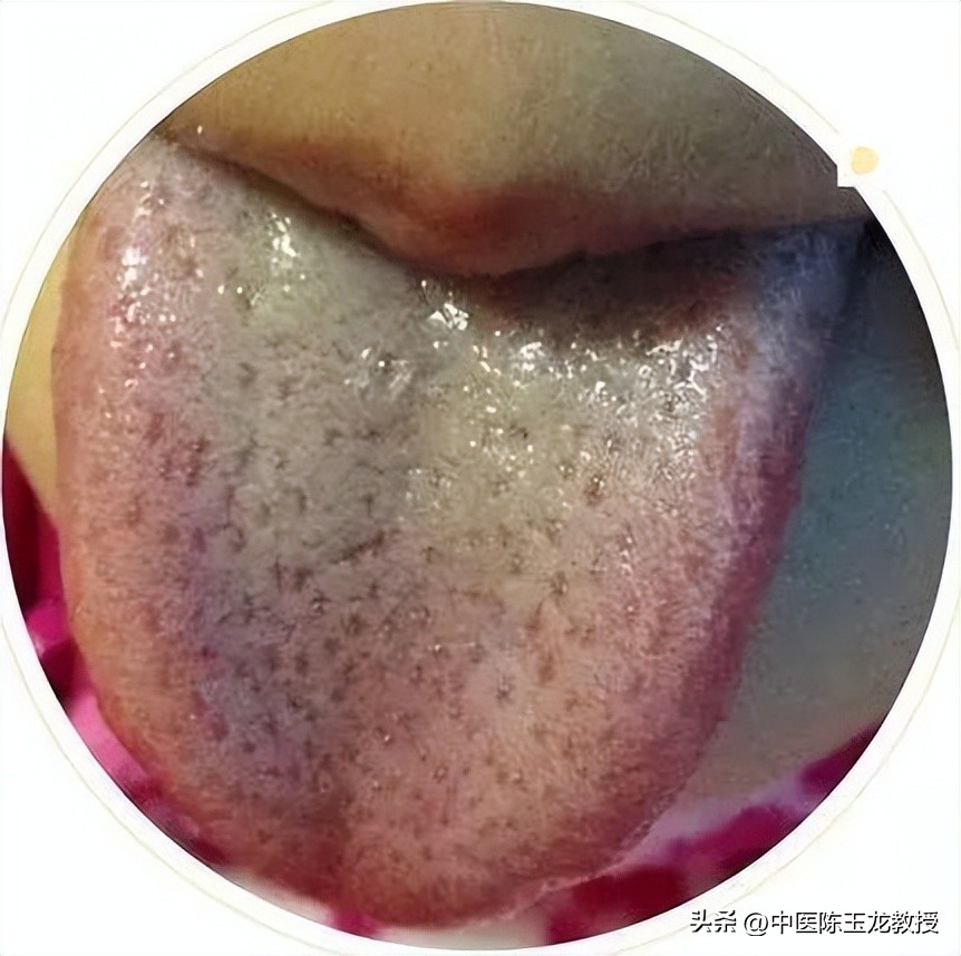 腋窝出汗是因肝经湿热,肝郁腋窝出汗多怎么调理