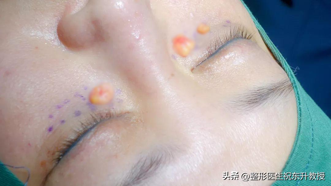 做过眼袋手术的视频,做眼袋经验足的医生