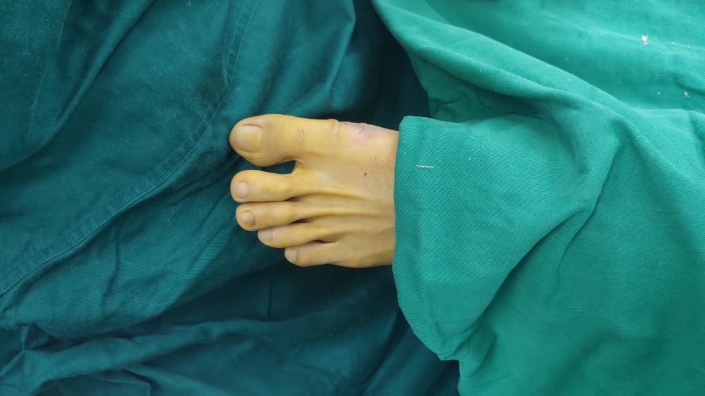 大脚骨轻微拇外翻怎么治疗好得快,大脚骨拇外翻最好的保守治疗方法