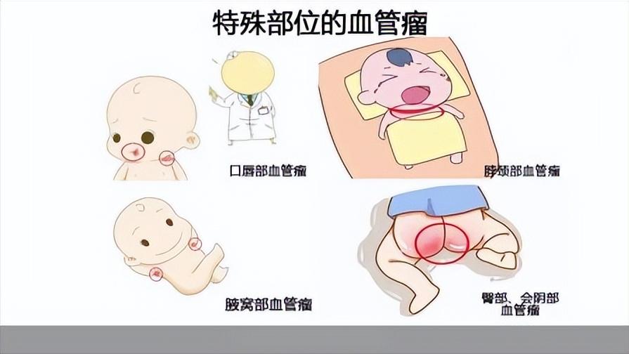 普萘洛尔可以用来治疗血管瘤吗,普萘洛尔治疗血管瘤的注意事项