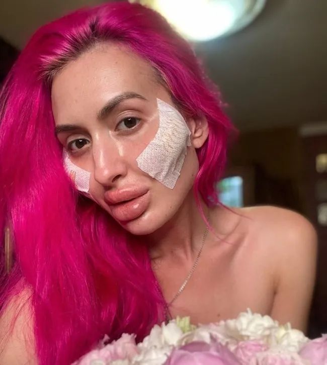 这个动手术打造世界最高颧骨的女人，再次向自己的颧骨下手了