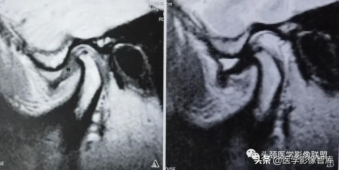 颞下颌关节移位怎么处理,颞下颌关节盘变形怎么治疗