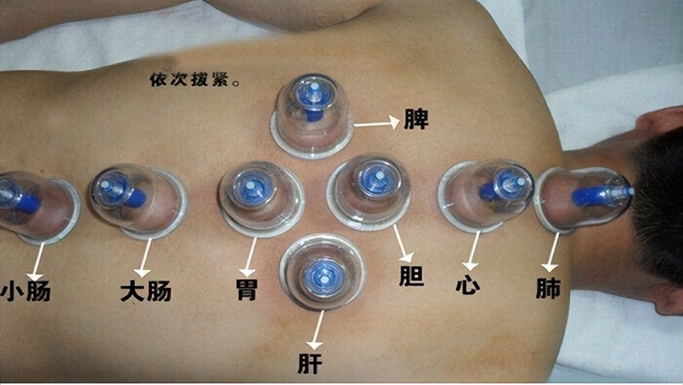 拔火罐益处和弊端,拔火罐有什么好处跟坏处呀