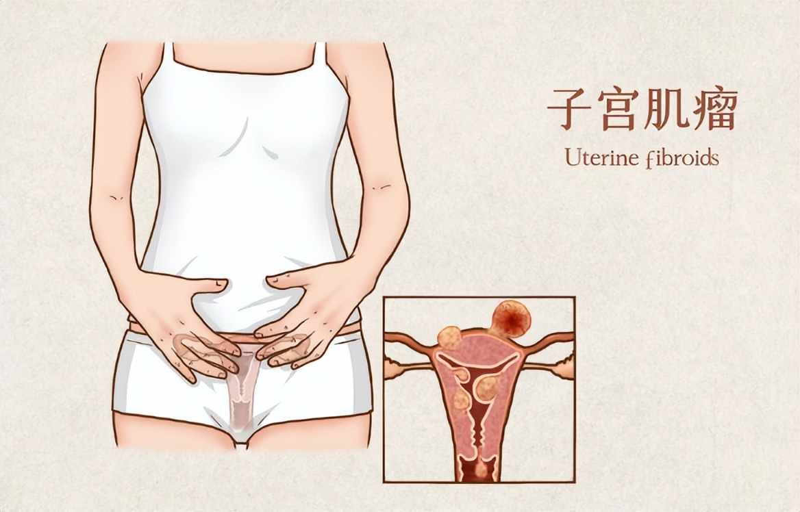 北京医院血管外科李鹏：女性多见子宫动脉栓塞，特点有哪些？