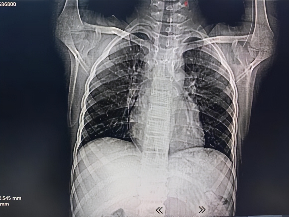 picc拔管遇导管断裂如何处理,picc导管断裂的影像表现