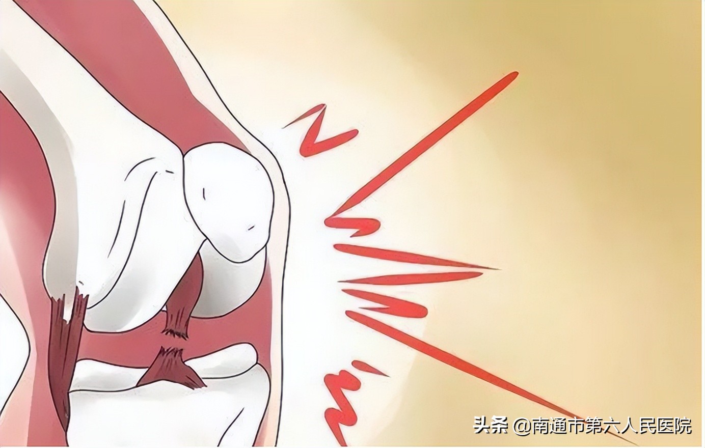 小伙打篮球前十字韧带完全断裂,小伙子打篮球双手断了