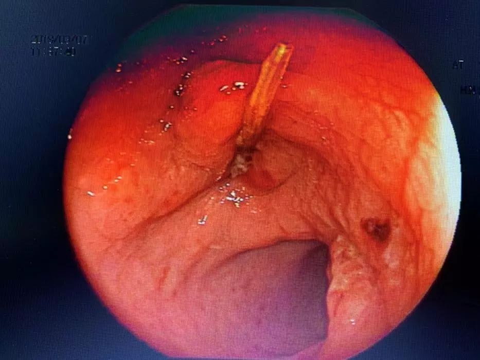 误吞牙签怎么办,少年误吞牙签一个小妙招
