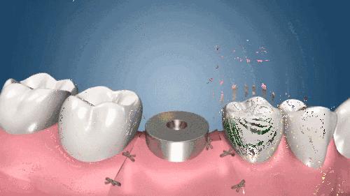 种植牙一颗多少钱才正常？五千到一万八的价格区间是否有猫腻