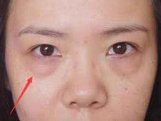眼袋和卧蚕修复,眼袋大很显老一招眼袋变卧蚕