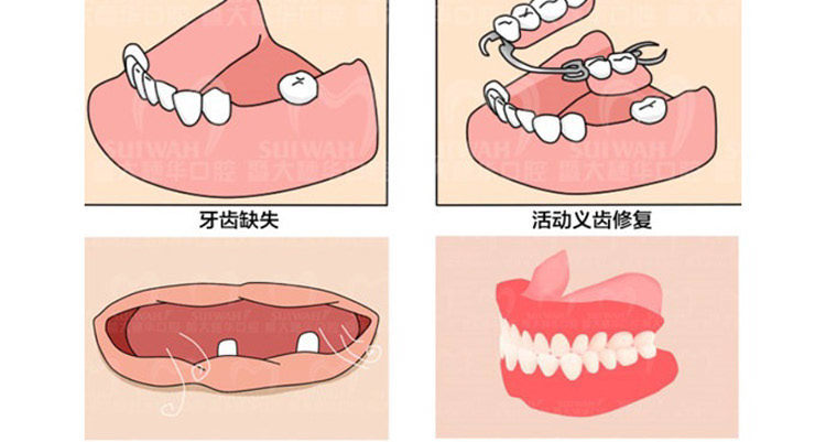 活动假牙的正确佩戴方法,活动假牙爱掉咋办