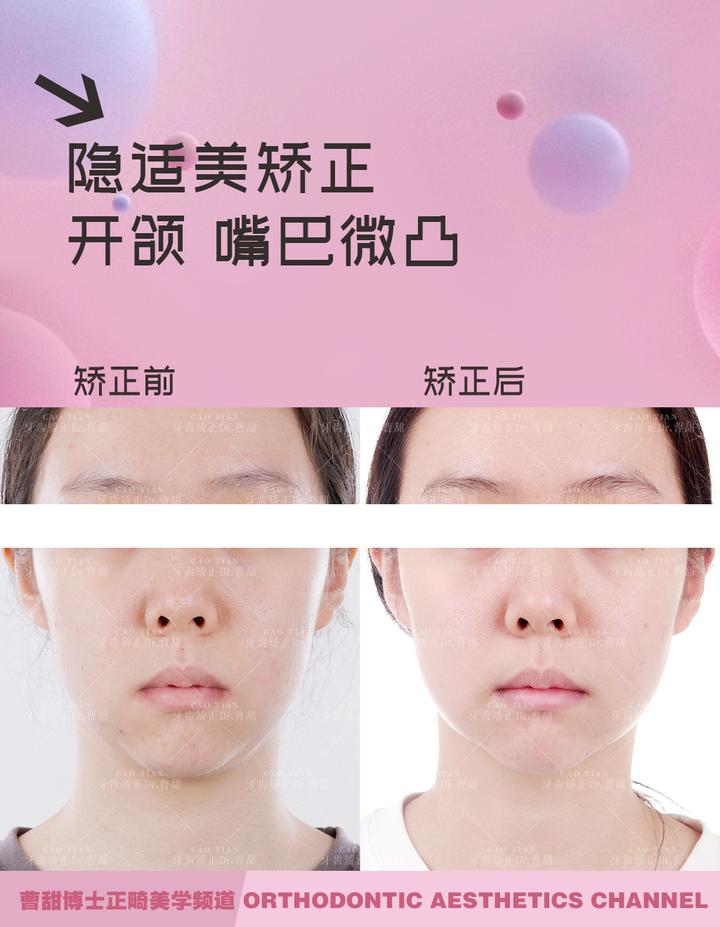 上下牙无法咬合是怎么回事,30岁牙齿咬合开颌还有必要矫正吗