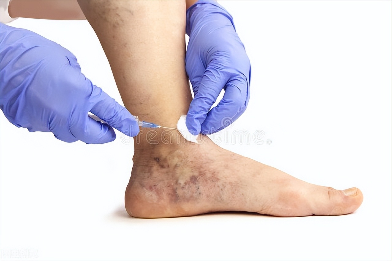 胃底静脉曲张破裂出血了怎么办,下肢静脉曲张破裂出血怎么办