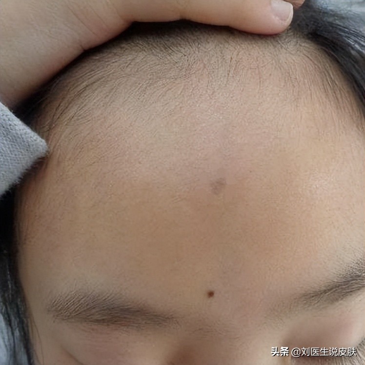 晕痣型白癜风初期和中期的区别,早期晕痣型白癜风怎么治疗