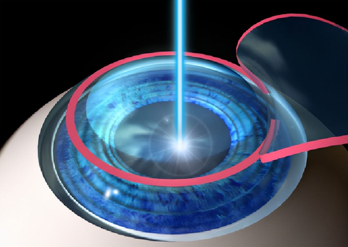 除了激光手术还有什么能矫正近视,近视植入晶体好还是激光矫正好