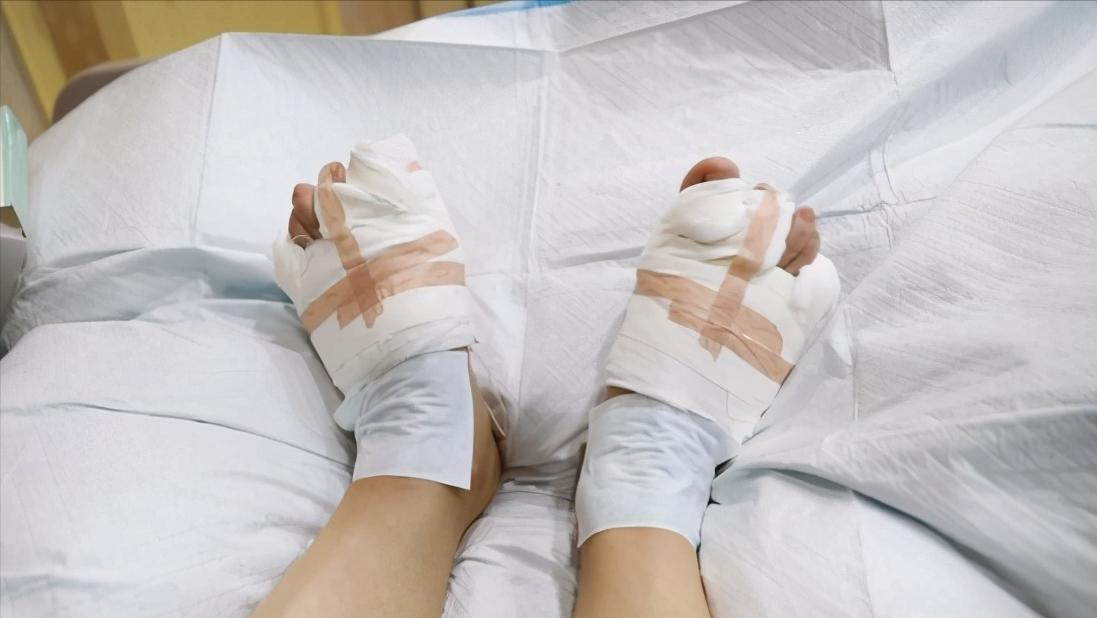 大拇脚趾外翻用什么矫正方法,大脚趾外翻歪怎么办