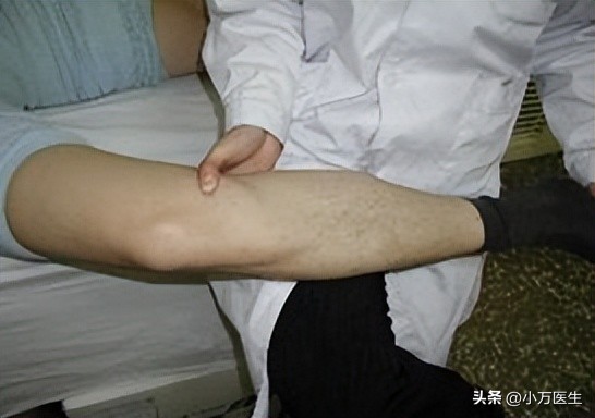 半月板后角撕裂微创手术,半月板撕裂分型