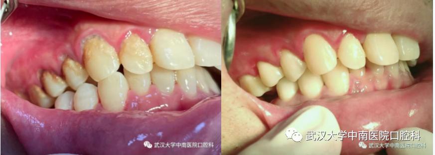 洗牙牙缝变大的原因和解决方法,牙缝特别小怎么洗牙