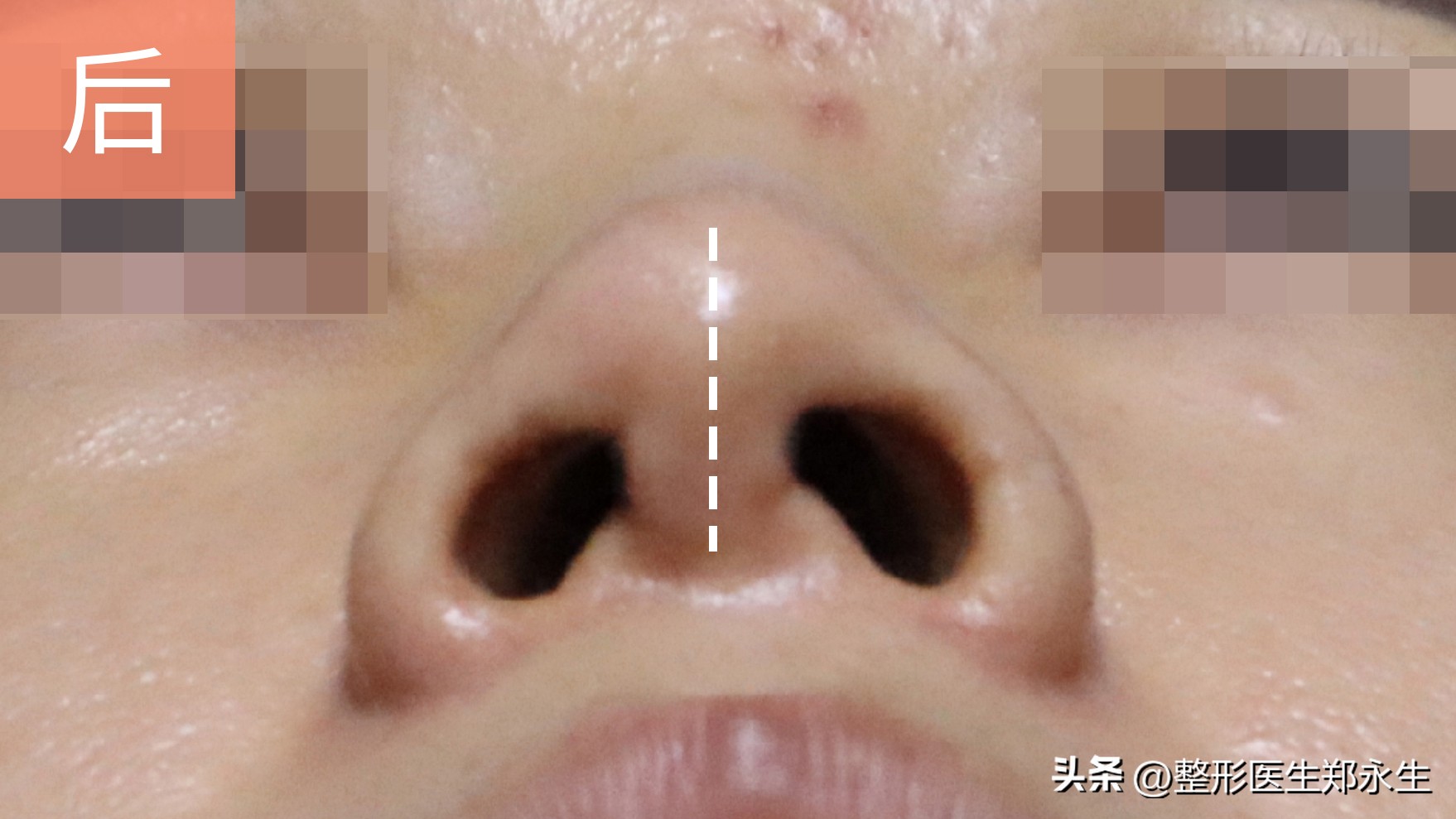 被老公打歪鼻骨留下后遗症,女的鼻子被打歪了