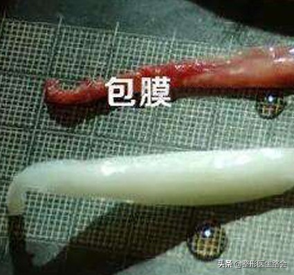 鼻子硅胶假体取出来真实感受,取出硅胶假体鼻子1-7天恢复过程图