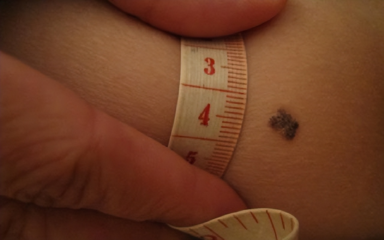 身上长红痣好还是长黑痣好,身上的痣出现这些变化小心会癌变