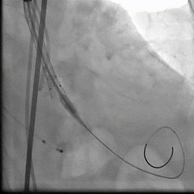 主动脉瓣狭窄病例讨论,25岁主动脉瓣狭窄用什么治疗方案