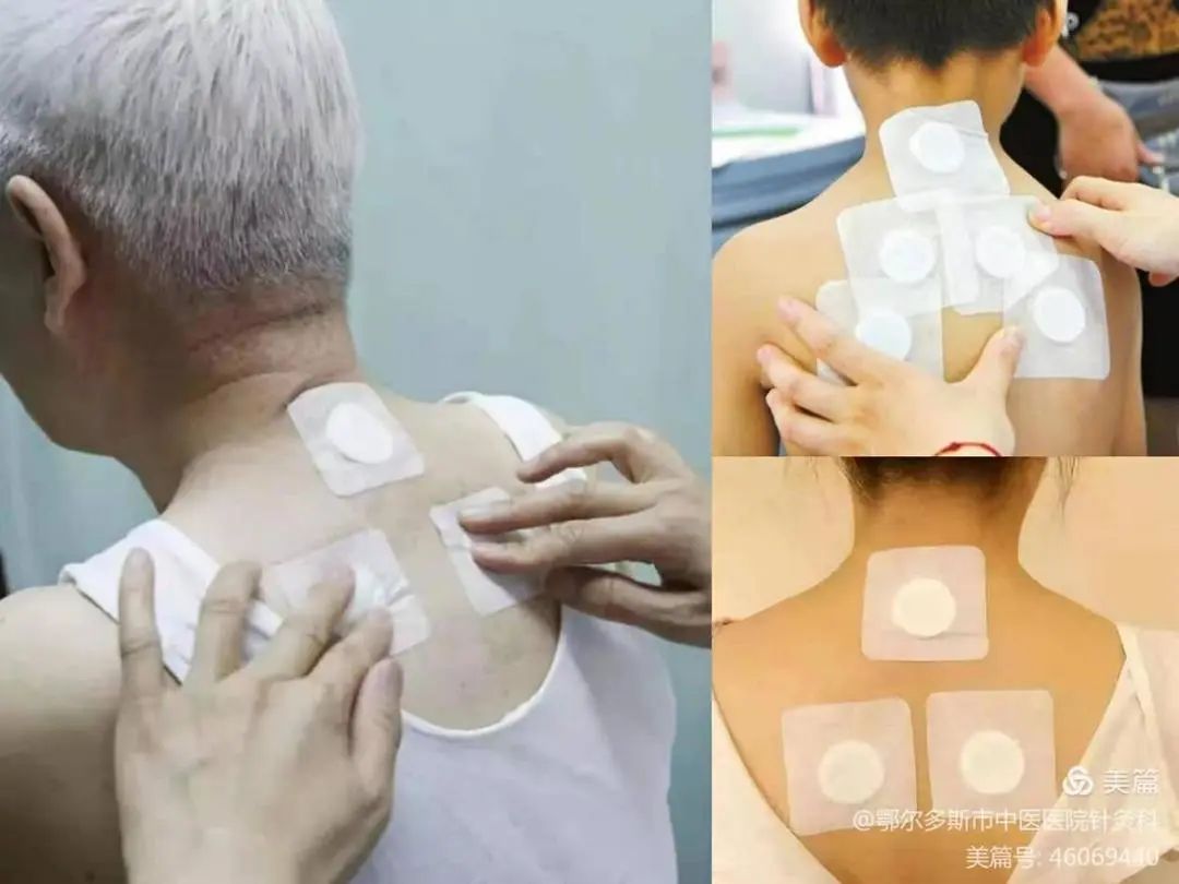 冬病夏治的针灸要连着做三天吗,冬病夏治正当时三伏贴即将开始