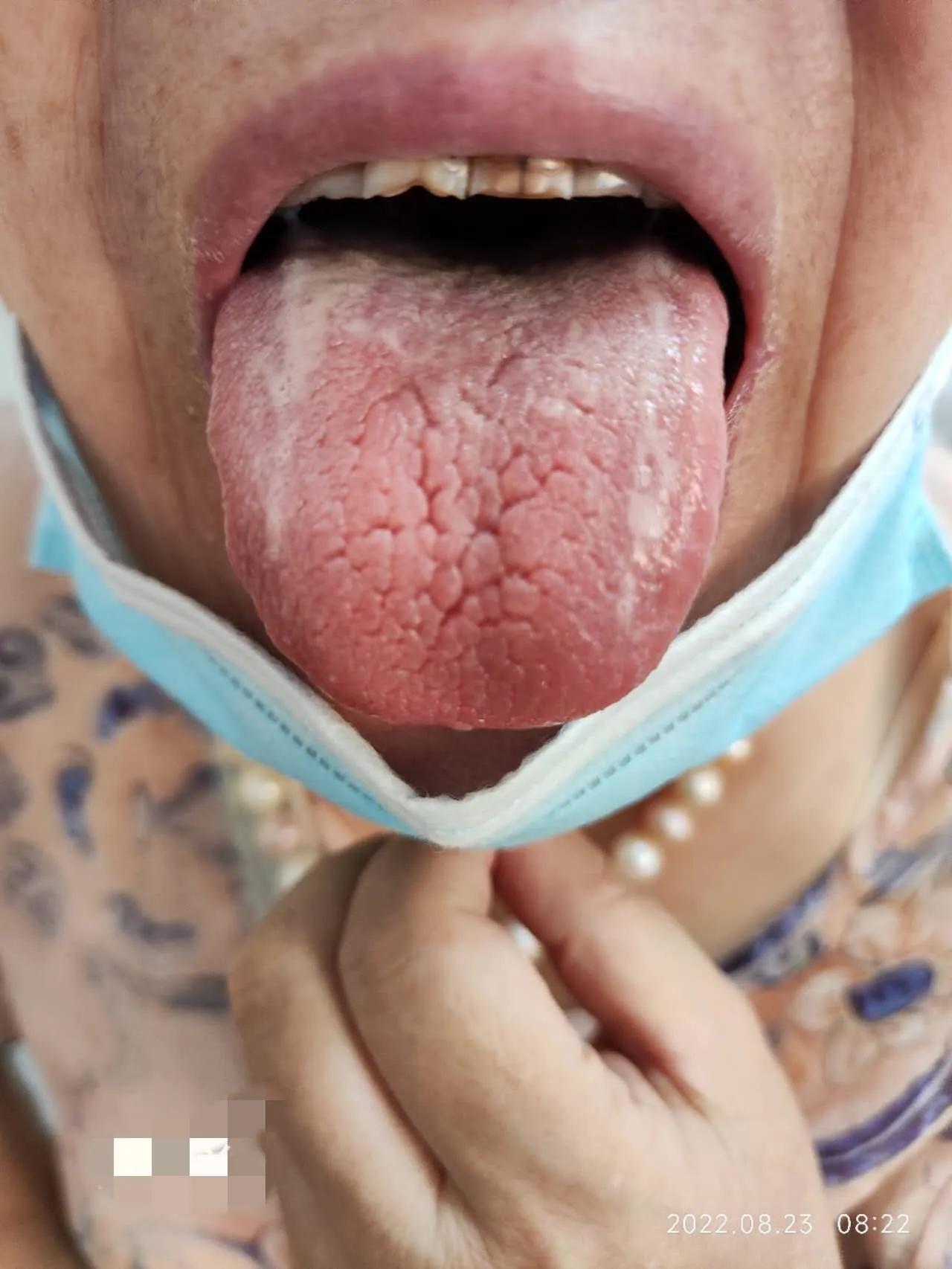 干燥综合征吃中药多久可以控制,干燥综合征喝中药可以治愈吗