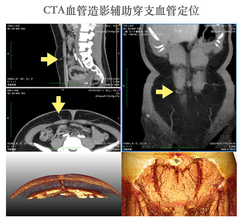 乳腺癌一期假体再造术,乳腺癌乳房再造术