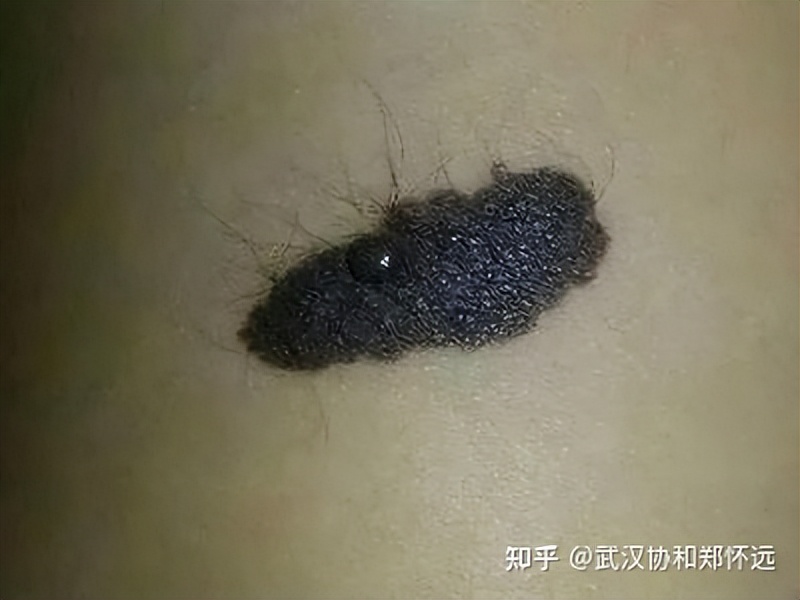 文东恩的伤疤令人心惊，身上的兽皮痣到底要不要治？