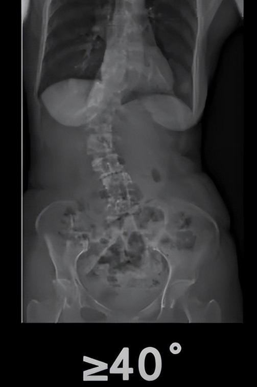 有哪些原因引起脊柱侧弯,有轻微脊柱侧弯怎么办