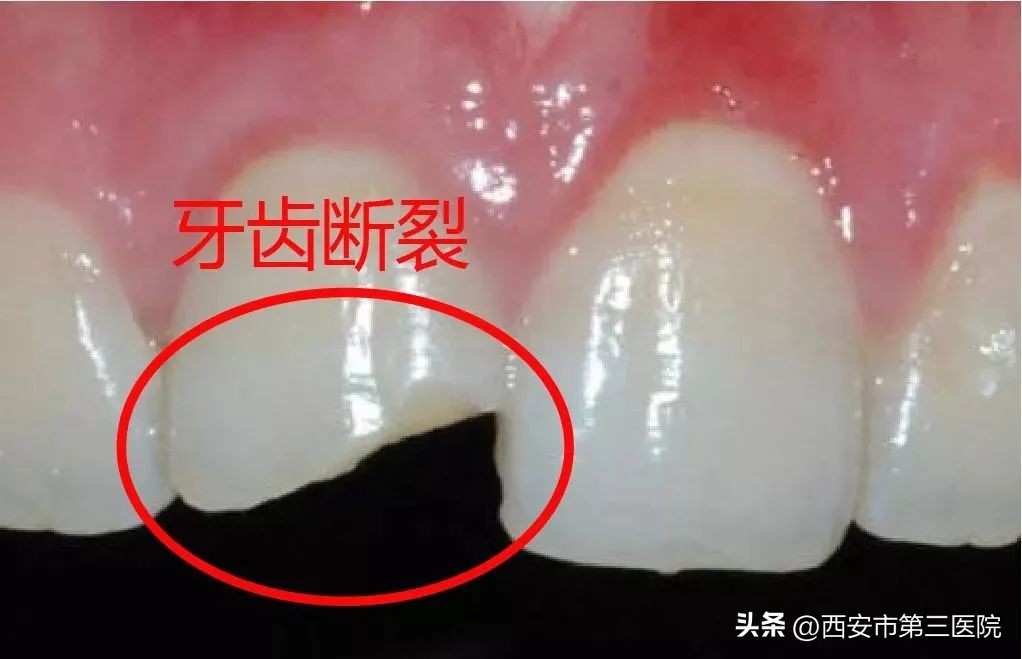 牙齿外伤的急救常识,科技之春三减三健