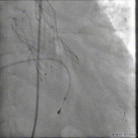病例回顾与分享,腹膜后血肿介入治疗