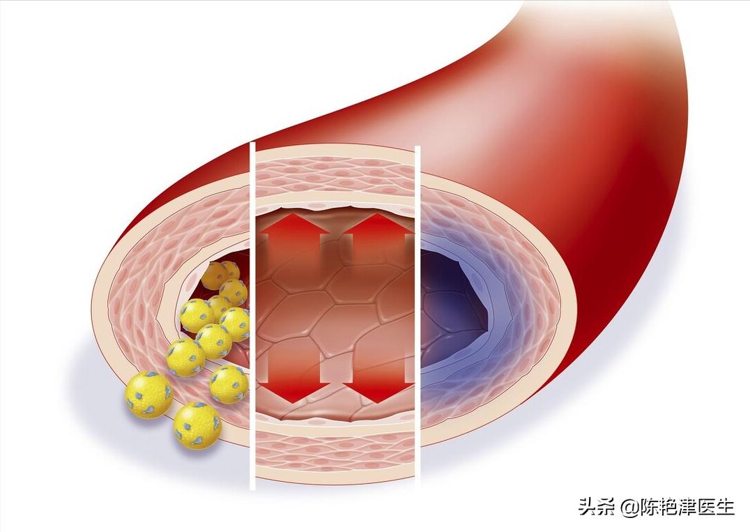 医生测血脂,医生一步一步教您看血脂
