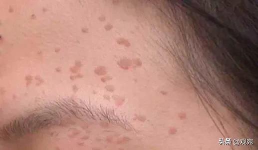 26年前，南阳人张毅的美容论文在《中医外治杂志》发表