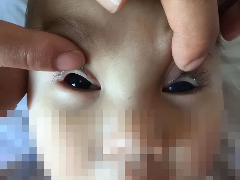 lowe综合征,继发性青光眼临床症状