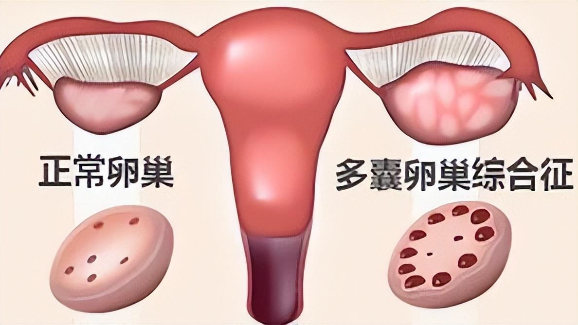 多囊卵巢综合征怎么防脱发,多囊卵巢综合征导致月经推迟长痘