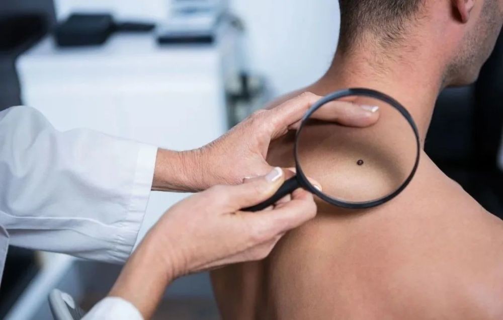 一旦皮肤上长了这5种痣,十有八九是黑色素瘤,一拖再拖会很麻烦